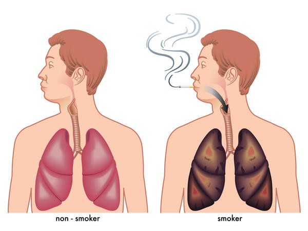 سیگار کشیدن عامل انسداد مزمن ریوی