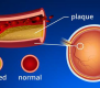 سکته چشمی و درمان آن با استفاده لیزر شبکیه چشم