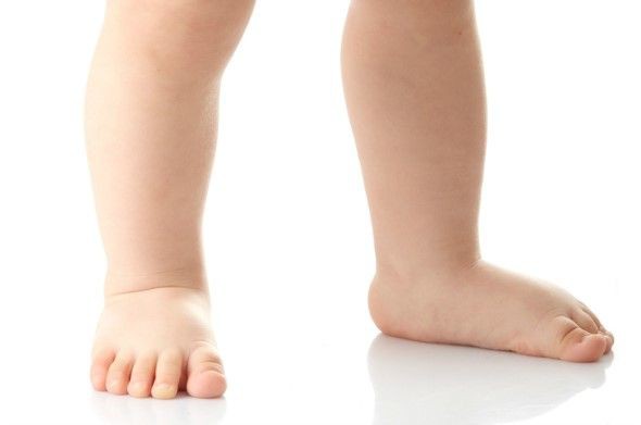 آیا جراحی کف پای صاف در کودکان ضروری است؟