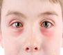 علائم آلرژی چشمی