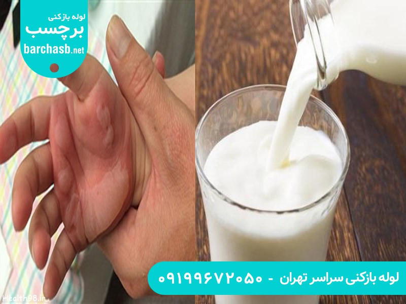 درمان سوختگی با اسید لوله بازکن با شیر