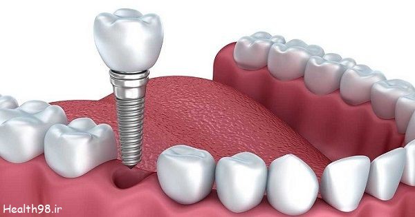 راه‌های مختلف جایگزین دندان کشیده شده