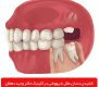 زمان کشیدن دندان عقل با بیهوشی در کلینیک دکتر دهقان