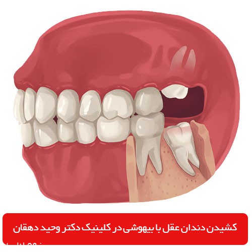 زمان کشیدن دندان عقل با بیهوشی در کلینیک دکتر دهقان