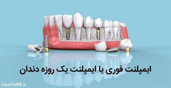 ایمپلنت فوری یا ایمپلنت یک روزه دندان