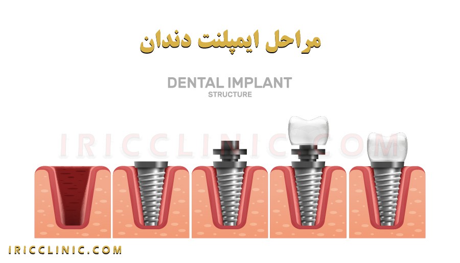 روش های کاشت ایمپلنت دندان