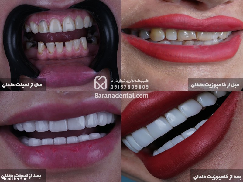 لمینت و کامپوزیت دندان در مشهد