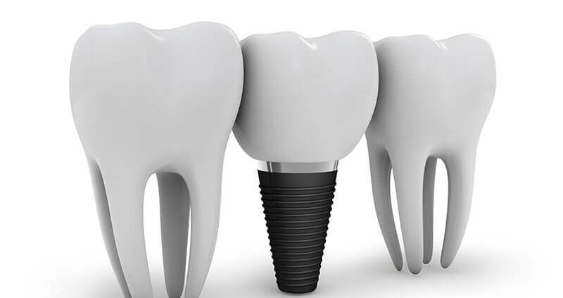 ایمپلنت دندان بهتر است یا بریج دندان