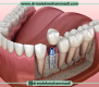 مراقبت‌های ضروری بعد از ایمپلنت دندان