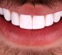 لمینت دندان چیست؟ | هرآنچه لازم است از لمینت دندان بدانید!