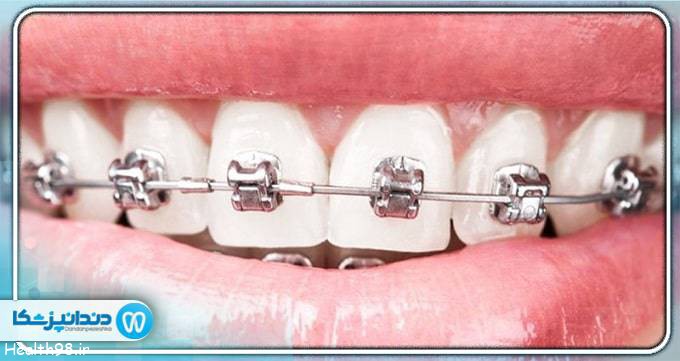 مزایا ارتودنسی دندان