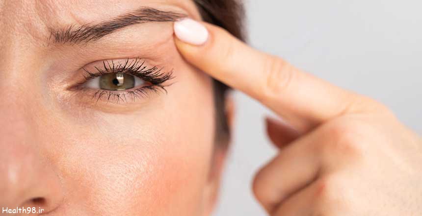 درمان افتادگی پلک در یک جلسه بدون درد با بلفاروپلاستی