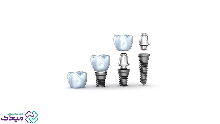 بهترین نوع ایمپلنت دندان کدام است؟